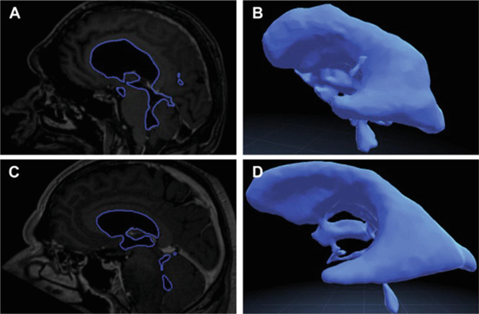 Ventricular segmentation